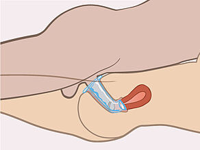 تعمل الحلقة الخارجية على تثبيت الواقي في موضعه عند ممارسة الجماع الجنسي. 