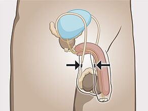 Erkeklerin kısırlaştırılması: sperm kanalı engellenir.